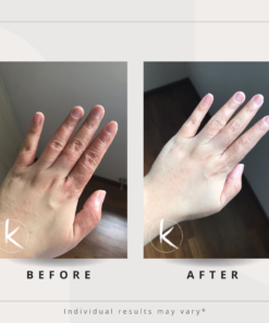 Eczema Testimonial